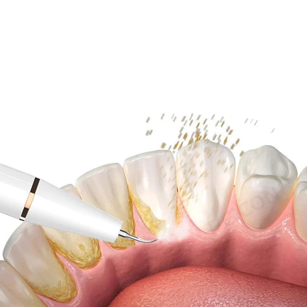 Détartreur Ultrasonique & Éliminateur De Plaque Et Tartre – Nettoyage Profond Pour Un Sourire Plus Blanc et Plus Sain Beauty & Personal Care Electro Paris